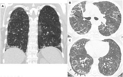 Presenting clinical and imaging features of patients with clinically amyopathic interstitial lung disease associated with myositis-specific autoantibodies